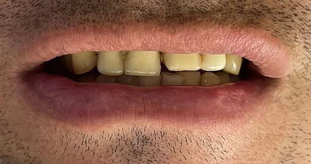 Antes: dientes desparejos