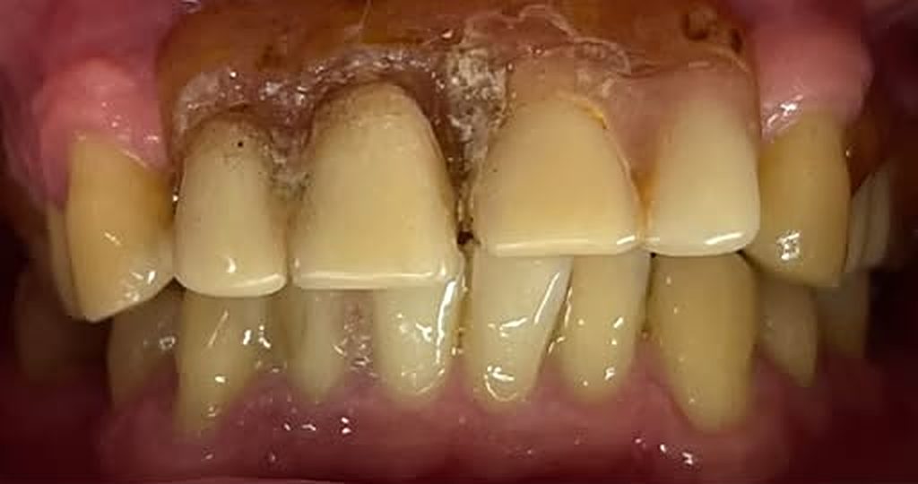 Antes: dientes con sarro y desgaste