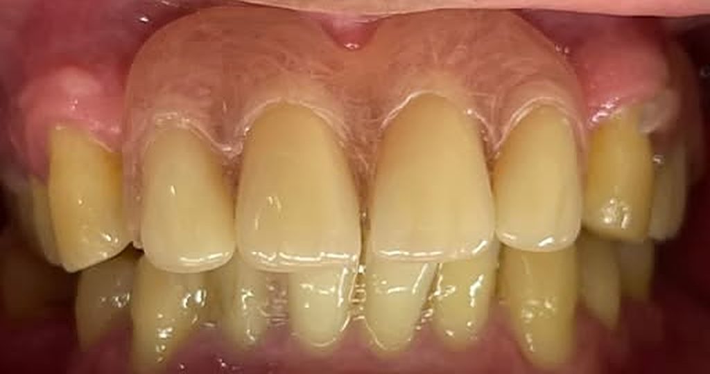 Después: dientes limpios y restaurados