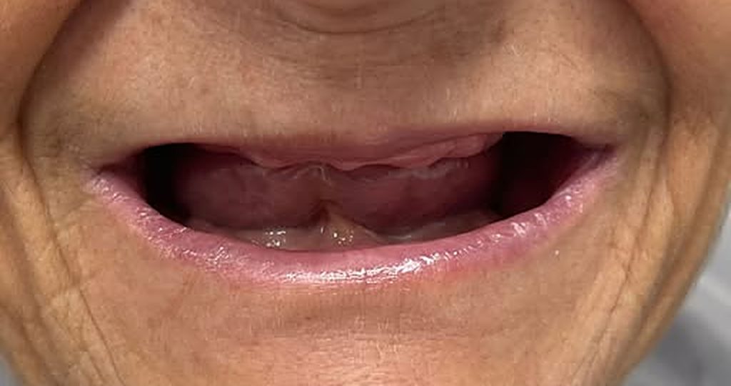 Antes: boca sin dientes visibles