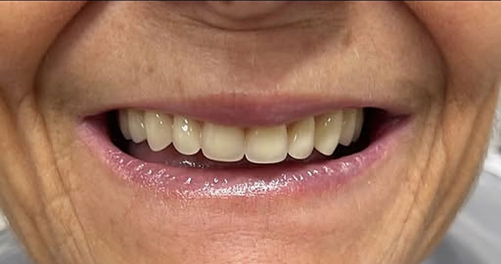 Después: sonrisa completa con prótesis