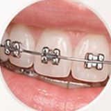 Dientes con brackets metálicos