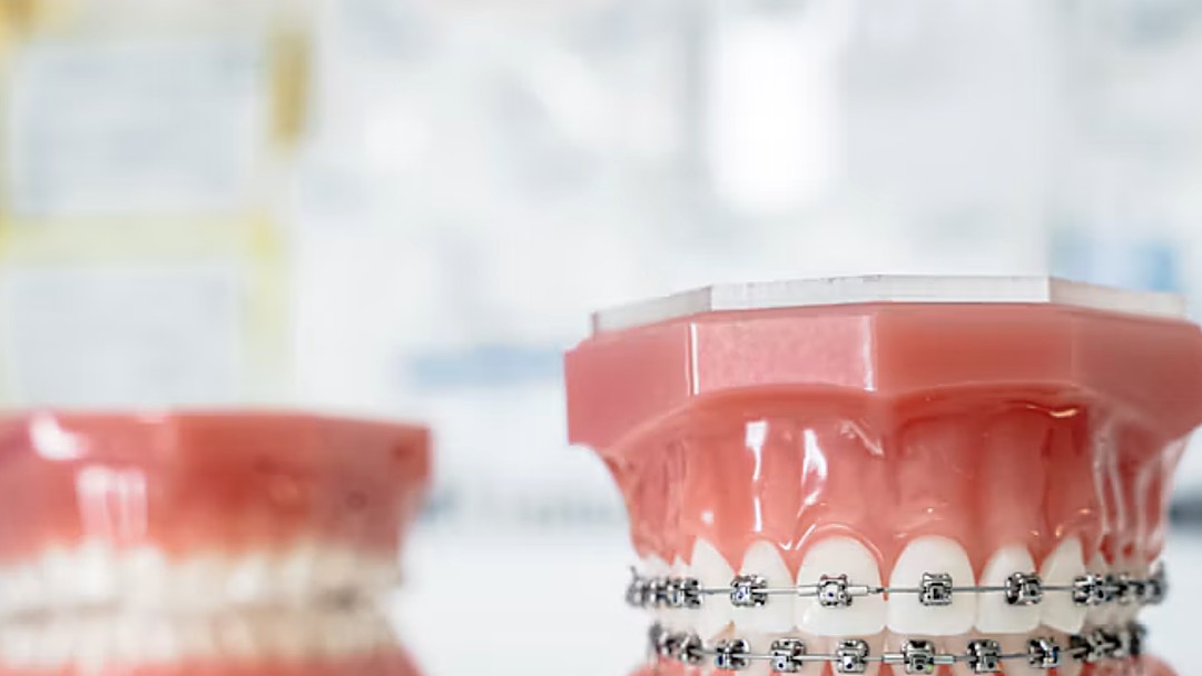 Dientes con brackets metálicos